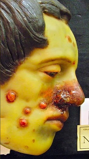 C'est quoi la syphilis ?