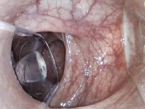 Speculum pussy – Yaha_ferh Latina Anal Insertion, Speculum, Endoscope, Venous Colon – Premium user Request