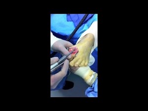 First Big Toe Joint Replacement Surgery with "Primus" Implant • Video • MEDtube.net
