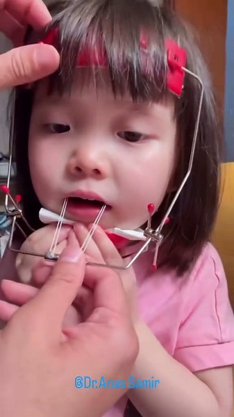 جهاز تقويم الأسنان: فوائد ومعلومات