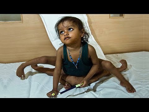 People With Extra Limbs Who Shocked The World