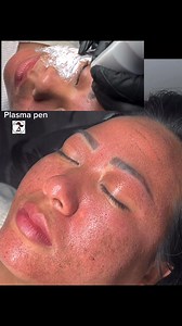 ❇️Plasma pen treatment is a non-surgical cosmetic procedure that uses a handheld device to create tiny micro-injuries in the skin, stimulating collagen and elastin production. ❇️ Benefits: Reduces wrinkles and fine lines, Tightens and lifts sagging skin, Improves skin texture, Treats acne scarring, and Non-surgical and minimally invasive. 🍀🍀🍀🍀🌱🌱 #everyonehighlightsfollowers @highlight | Zonuni Skincare