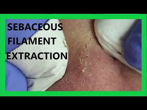Sebaceous FILAMENT Extraction.