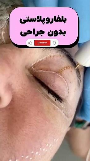 بلفاروپلاستی بدون جراحی با پلکسر | Non-Surgical Blepharoplasty with Plexr