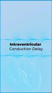 #ECG Intraventricular conduction delay (IVCD) is a critical ECG finding, marked by a widened QRS complex (≥120 ms), reflecting delayed electrical conduction within the ventricles. Left bundle branch block (LBBB) is characterized by a deep S wave in lead V1, broad, single-peaked R waves in lateral leads (I, aVL, V5-V6), and a delayed R wave peak time (>60 ms in V5-V6), indicating left ventricular conduction impairment. Conversely, right bundle branch block (RBBB) presents with a QRS duration exce