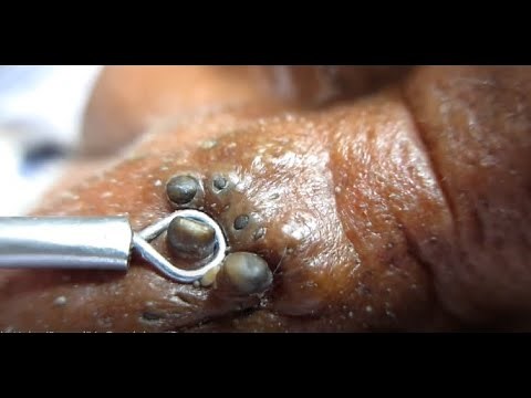 Big Big Comedones blackhead popping ever, blackhead removal most satisfying blackheads extraction