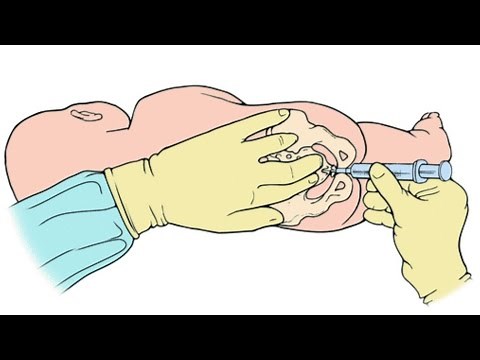 Caudal block demonstration by Dr. Ramesh, Pediatric Anaesthetist