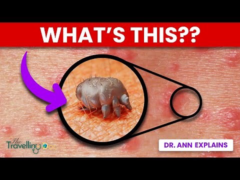 Is It Scabies? Rash Pictures, Night Itch & Best Treatment
