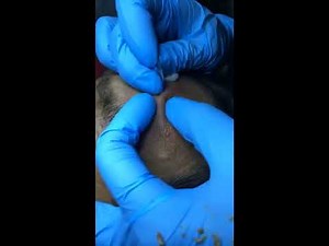 VERY BIG CYSTIC ACNE | BIG ACNE REMOVAL ON THE FACE #5