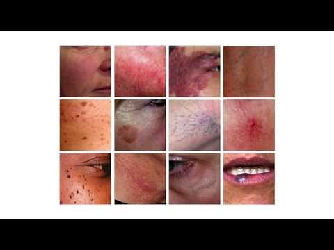Excel V System - Aesthetic laser for all skin tones.