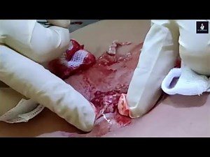 Infected Sebaceous Cyst on Back Incision and Drainage By DR Blackhead !