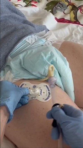 Catheter Care: Securing with a Statlock