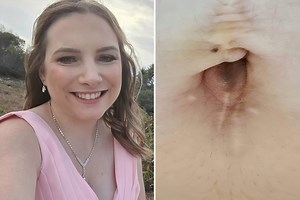 Teacher horrified as lining of her womb started seeping out of her BELLY BUTTON