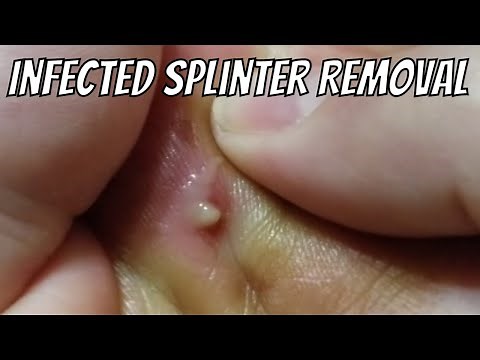 Big Puss Infected Splinter - Infection - Surgery - Emergency