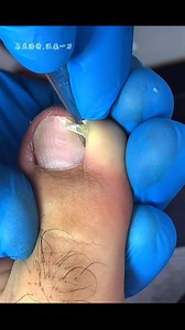 76K views · 407 reactions | Toenail Cleaning for Deep Build-Up and Overgrown Nails #fypシ゚viralシ | Medical Home | Facebook