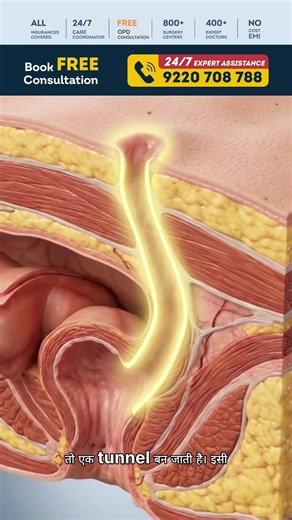 Anal Fistula Symptoms Explained | Pus, Wound & Infection Warning Signs