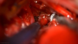 #246: Extended Retrosigmoid Craniotomy for Trapping of Ruptured, Dolichoectatic Basilar Perforating Artery Aneurysm - All Videos - Seven Series Collection