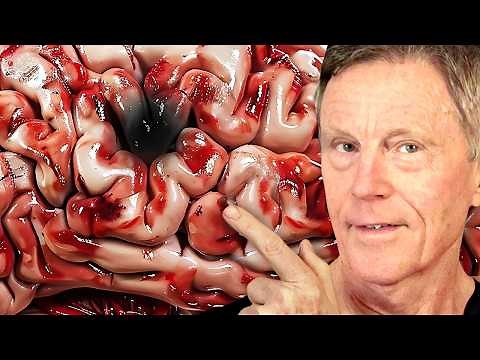 I AVOIDED a Stroke: My Atrial Fibrillation Story