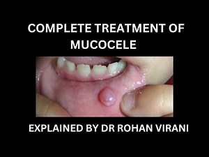 COMPLETE TREATMENT FOR MUCOCELE - EXPLAINED BY DR ROHAN VIRANI