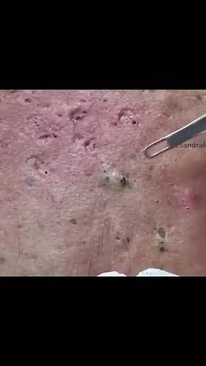 Blackheads for Days!!!