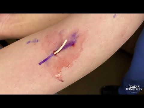 Arm Implant Removal | CONTOUR DERMATOLOGY