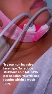 Try our non invasive laser lipo. To reduce stubborn chin fat. $115 per session. You will see results within a week time. #NonInvasiveTreatment #chinlipo #miamibeach #westpalmbeach | Ayanna Providence