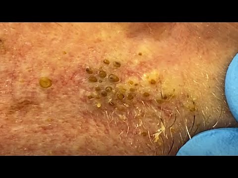 Extreme Blackhead Extraction Summer Throwback | CONTOUR DERMATOLOGY
