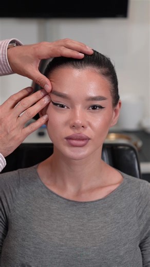 Endoscopic temporal lifting and Cateyes surgery 👏👏👏 #cateyessurgery #foxeyessurgery #midfacelifting #endoscopictemporallift #barbienose