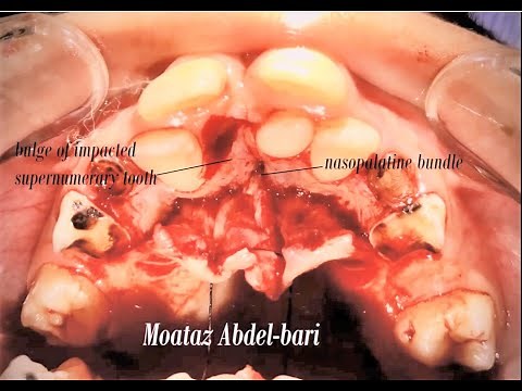 Surgical Extraction of palatal Impacted supernumerary Tooth
