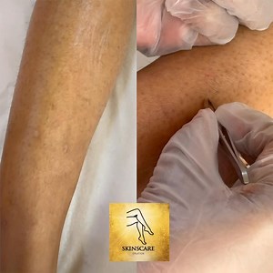 ⚡️ Électrolyse , Électro-Épilation chez Skinscare La solution précise et durable, adaptée à toutes les carnations et à tous types de poils. ✨ ✅ Avantages & bienfaits : 👉Ciblage poil par poil = résultat net et uniforme 👉Idéal pour les zones délicates et les finitions (menton, lèvre, ligne maillot…) 👉Aide à réduire les poils incarnés améliore l’aspect de la peau au fil des séances 👉Convient quand on cherche une méthode 100% personnalisée 💰 Séance à partir de 25.000 Ar 📅 Uniquement sur rendez