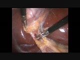Laparoscopic Cholecystectomy • Video • MEDtube.net