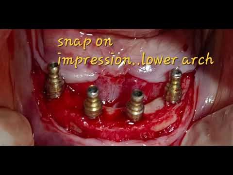 Situational implantology:Alternative to zygomatic implants, palatal approach.full mouth implants