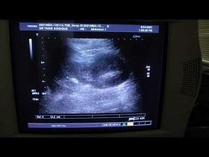 SPLENIC INFARCTION, SPLENOMEGALY , BILATERAL nephrolithiasis