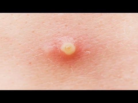 HOW TO GET RID OF PIMPLES ON YOUR FOREHEAD RIGHT NOW