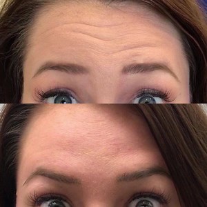 3.1K views · 22 reactions | A light dose of Botox reduces the appearance of fine lines without restricting movement. Watch to see the difference. | RealSelf | Facebook