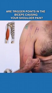 Are Trigger Points In The Biceps Causing Your Shoulder Pain ? 👉 Trigger points within the biceps muscle fibers, can develop due to overuse, poor posture, or muscle imbalances. 👉 Overuse activities like weightlifting or prolonged typing, as well as poor posture, contribute to the development of trigger points in the biceps. 👉 Trigger points in the biceps can refer pain to distant areas, with a common pattern being the development of shoulder pain. This discomfort is often described as a deep, 