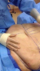 Plus-Size Tummy Tuck Using Fleur de Lis Pattern (GRAPHIC)