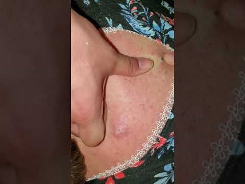 Intense Boil Explosion!