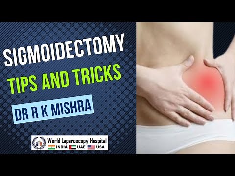 Tips and Tricks for Safe Laparoscopic Sigmoidectomy | Step-by-Step Expert Surgical Technique