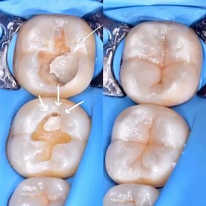 Pulp capping carious exposures in adults: calxium hydroxide or MTA? What is your protocol in this situation? Credit case by @joy_andrey #dentist #identistry #teeth | identistry | Facebook