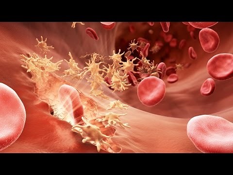 Understanding Hemophilia