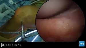 ACL Reconstruction of the Knee Using a Hamstring Graft