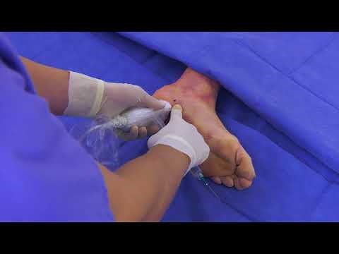 TenJet Plantar Fasciitis Procedure