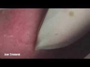 How To Remove Blackheads in the Nose Easy Don't forget to like, share & follow to get more videos! | Pimple Popping | Facebook