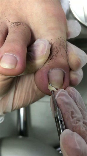 Quickly trim away the ingrown nail! #nails #pedicure