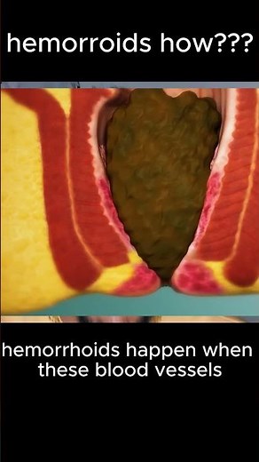How Blood Vessels Betray Your Body #health #hemorrhoids