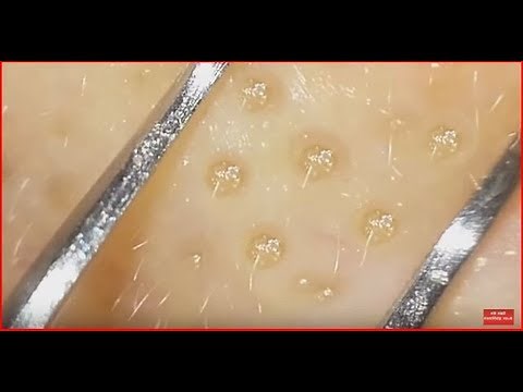 How to clean in depth clogged pores with clip curved tweezers.
