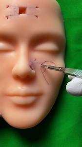 Cheek advancement flap: excision (part 2) | Dermhacks