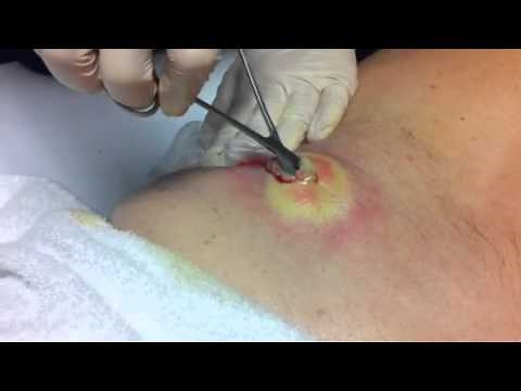 Lancing infected cyst / abscess