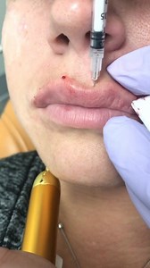 1.5K views · 12 reactions | Awesome Wowza Lip Enhancements with AAFE...